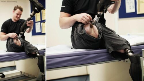 What is a Bone Anchored Prosthesis for Amputees - Osseointegration ...